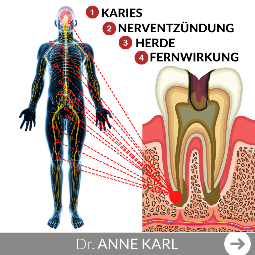 Fernwirkung von Krankheitsherden am Zahn